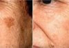 POZNATI DERMATOLOG OTKRIO: Ovo je uloga sode bikarbone u liječenju mrlja na licu!