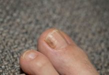 Neka gljivice budu prošlost: Da biste imali zdravu kožu i nokte uradite ovo