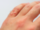 Nanesite je samo jednom i uklonite neugodne BRADAVICE