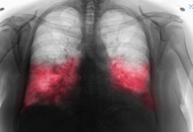 Raste broj zaraženih hodajućom upalom pluća: Ako imate ovesimptome javite se ljekaru